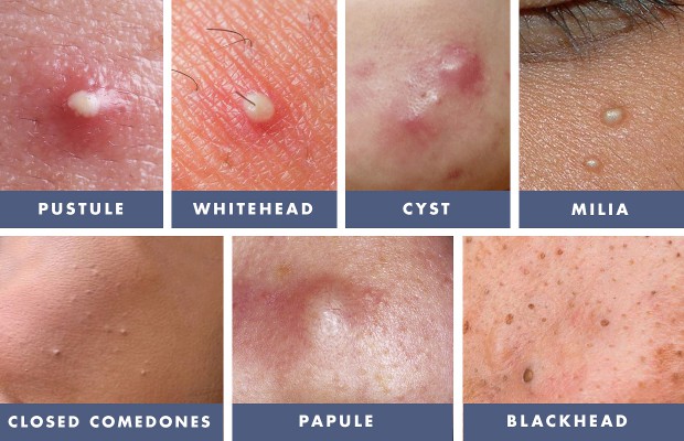 how-to-get-rid-of-whiteheads-blackheads-naturally