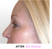 botox-making-you-look-older
