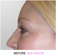botox