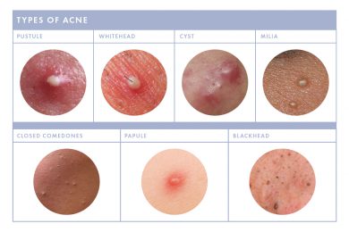 Whiteheads pustules papules