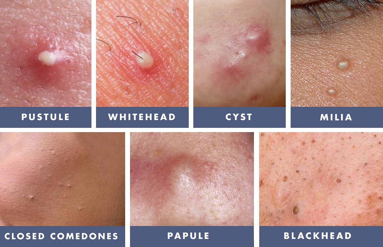 Apa Itu Blackhead Dan Whitehead at keithvspringero blog