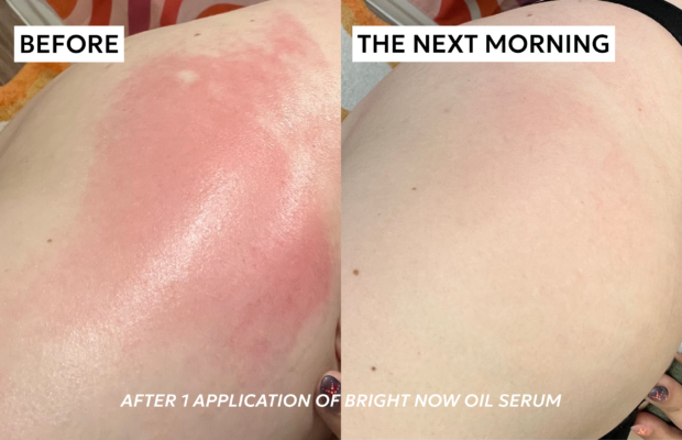 before and after using bright now oil serum on shoulder sunburn
