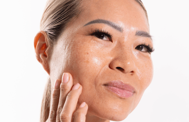 model touching cheek with hyperpigmentation, brown spots