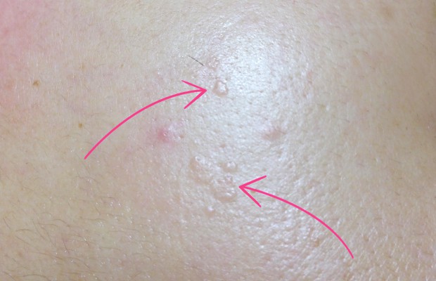 Common Lumps And Bumps On And Under The Skin What Are They Skin Bumps Reverasite