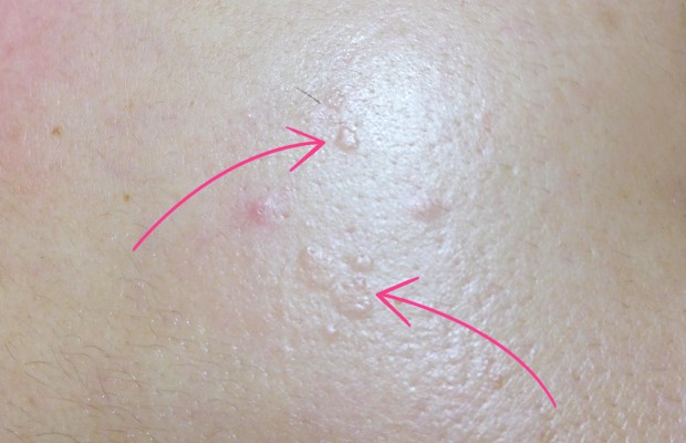 Types Of Bumps On Skin