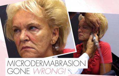 Microdermabrasion on a old woman's face