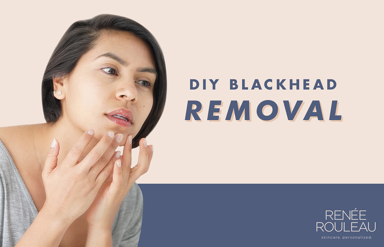 How To Manually Extract Blackheads And
