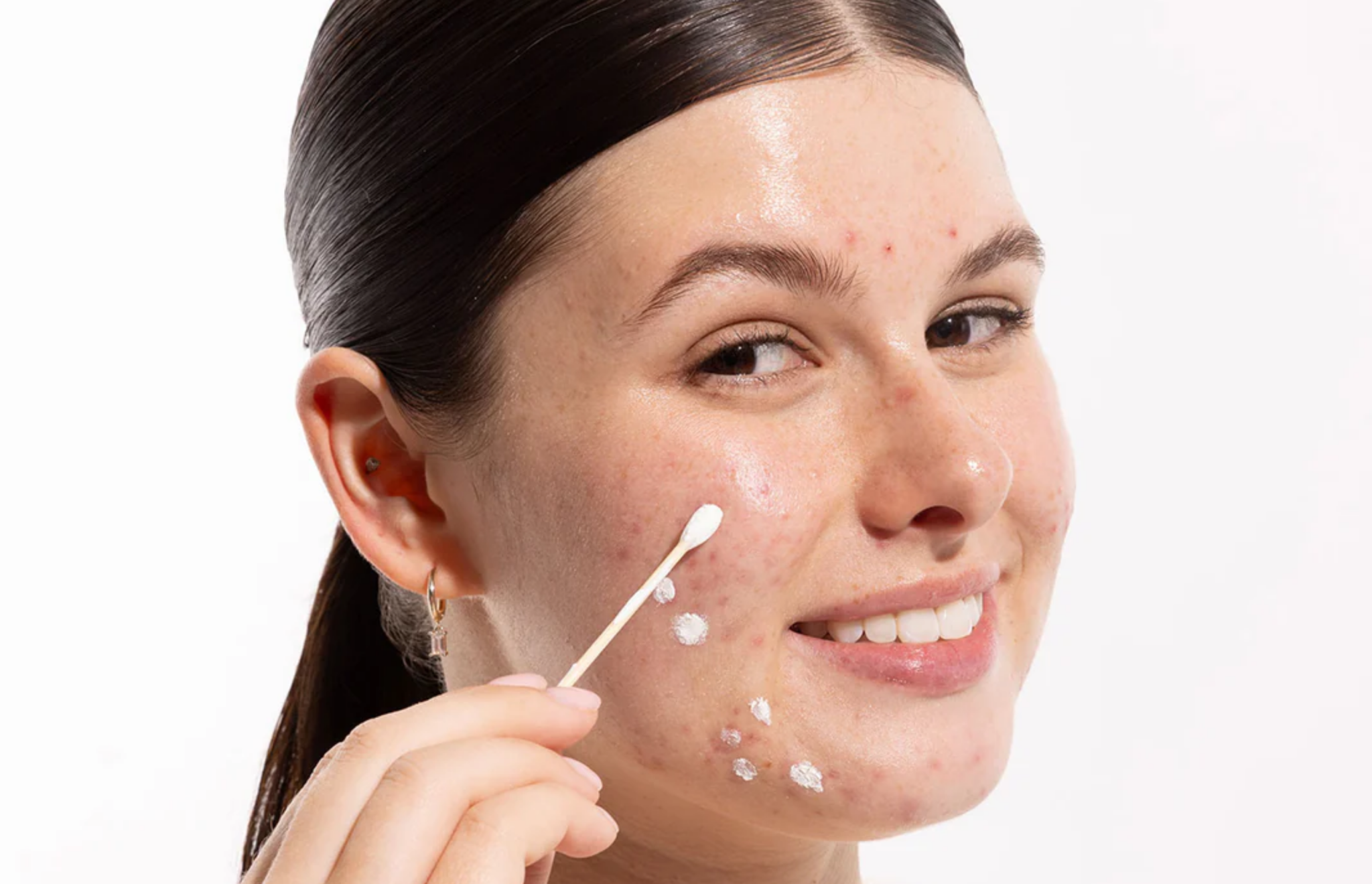 How to Get Rid of Stubborn Blemishes
