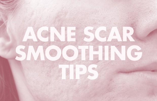 treating indented acne scars