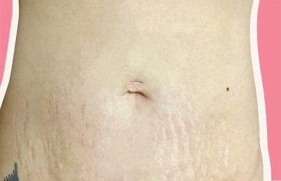 woman's stomach with stretch marks post pregnancy