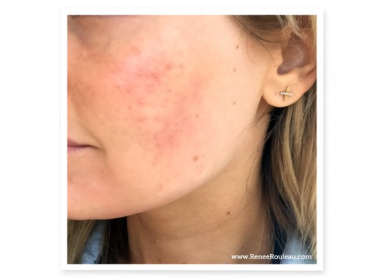 Rodeo vækstdvale evne Acne Cosmetica (Cosmetic Acne): What It is, Causes, & How To Treat It