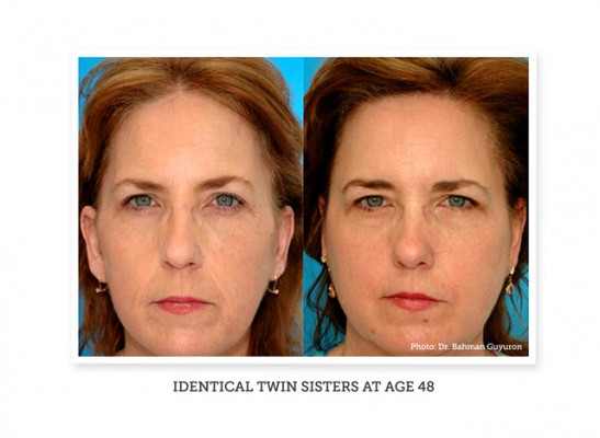 a woman before and after using wrinkle removing cream