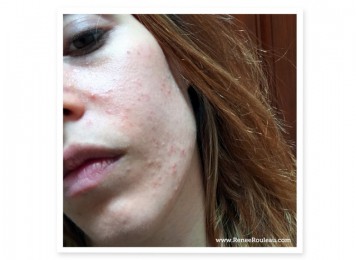 a woman with acne on her face