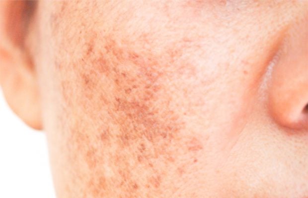 Top Ten Common Skin Spots - Advanced Dermatology of the Midlands