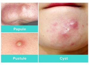 Do You Have Whiteheads, Blackheads, Pustules, Milia Or Cysts? - Expert ...