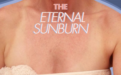 a woman with a sun burnt chest