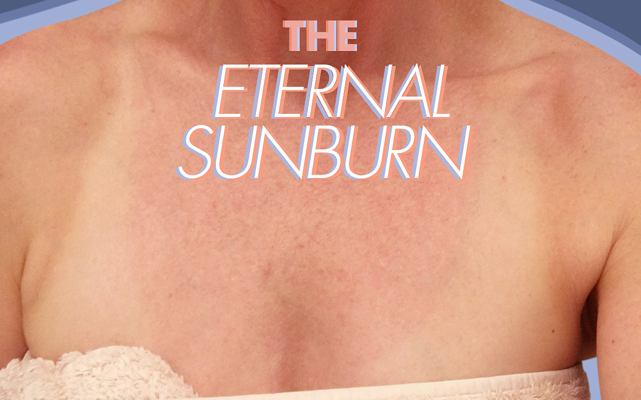 This Woman Had a Rash on Her Chest That Looked Like a Sunburn—But