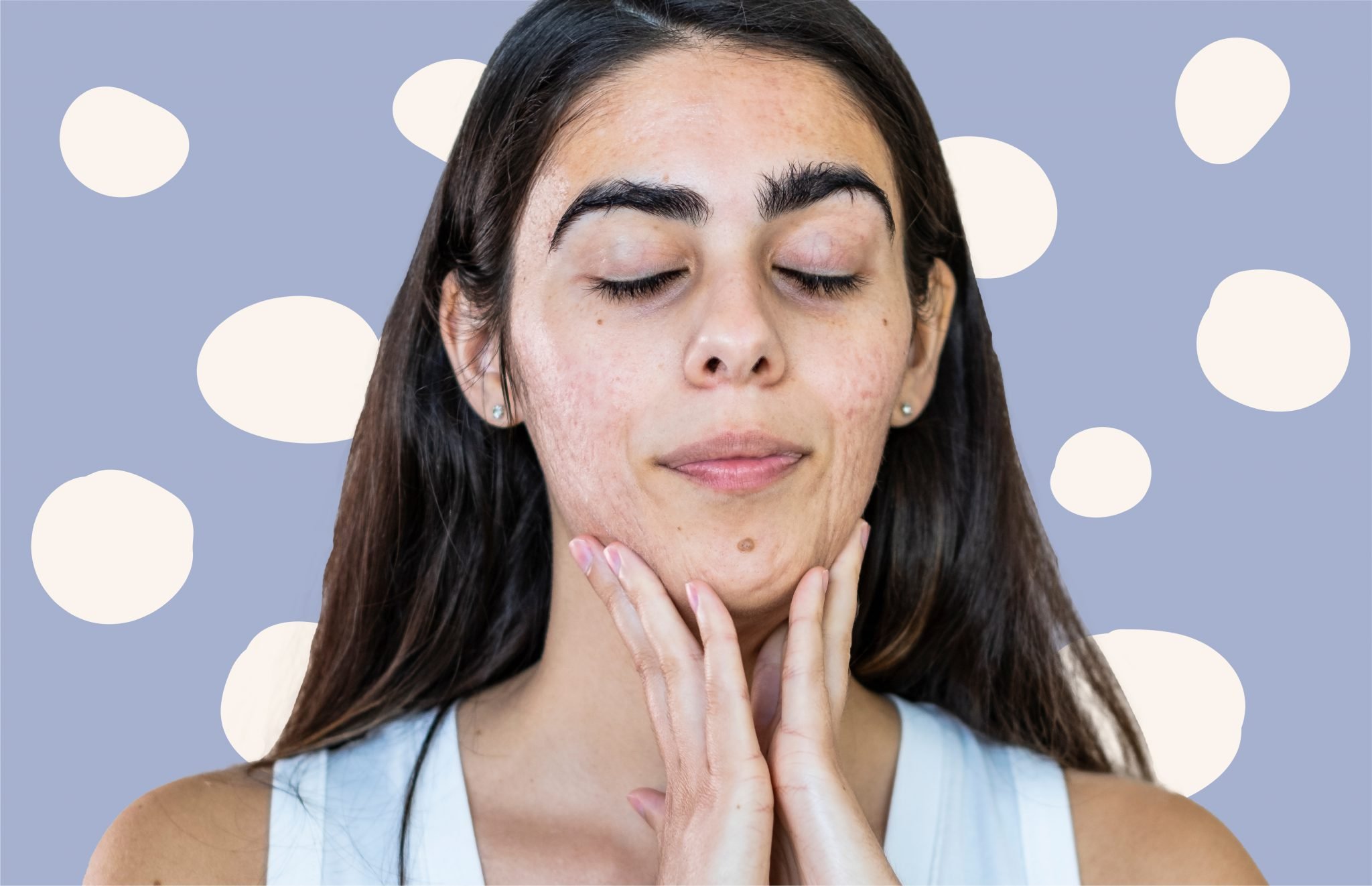 prevent-chin-jawline-breakouts-with-these-8-expert-approved-tips