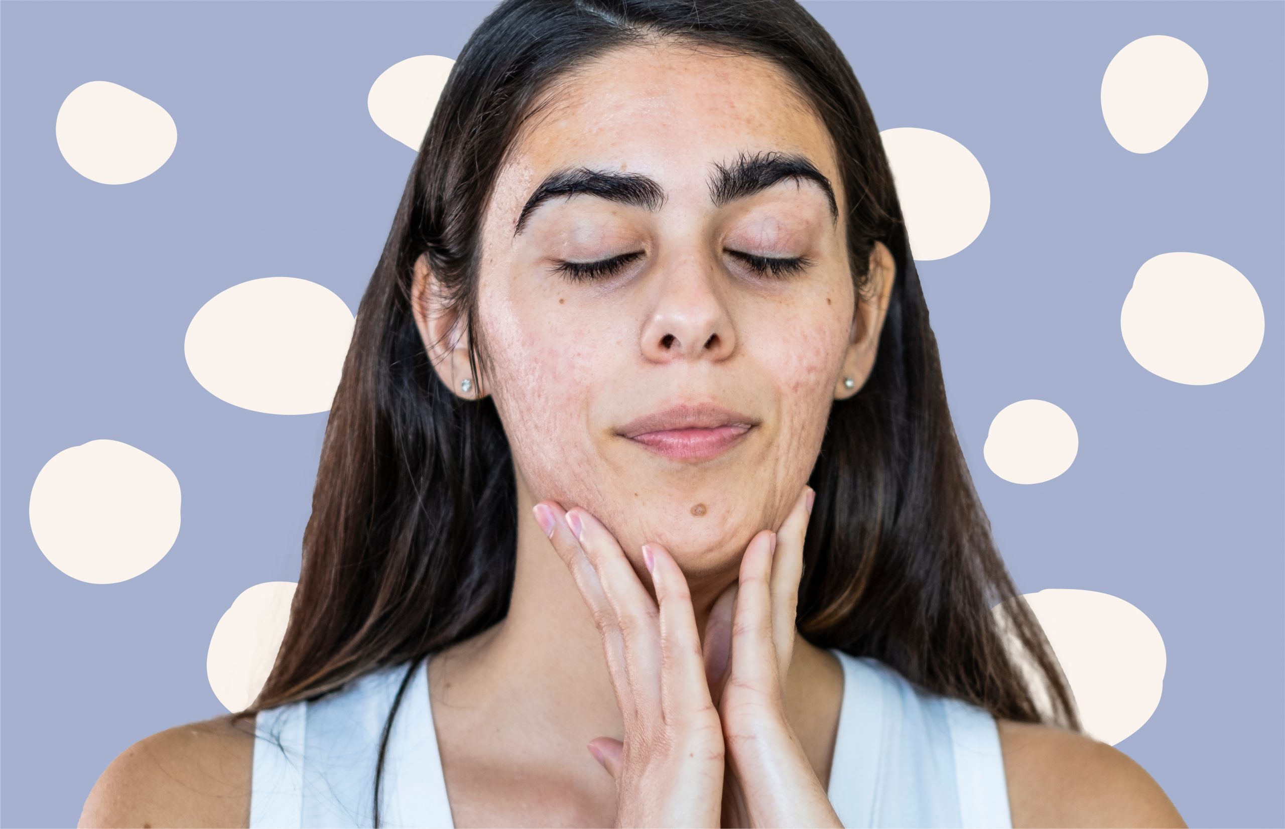 Prevent Chin & Jawline Breakouts With These 8 Expert-Approved Tips