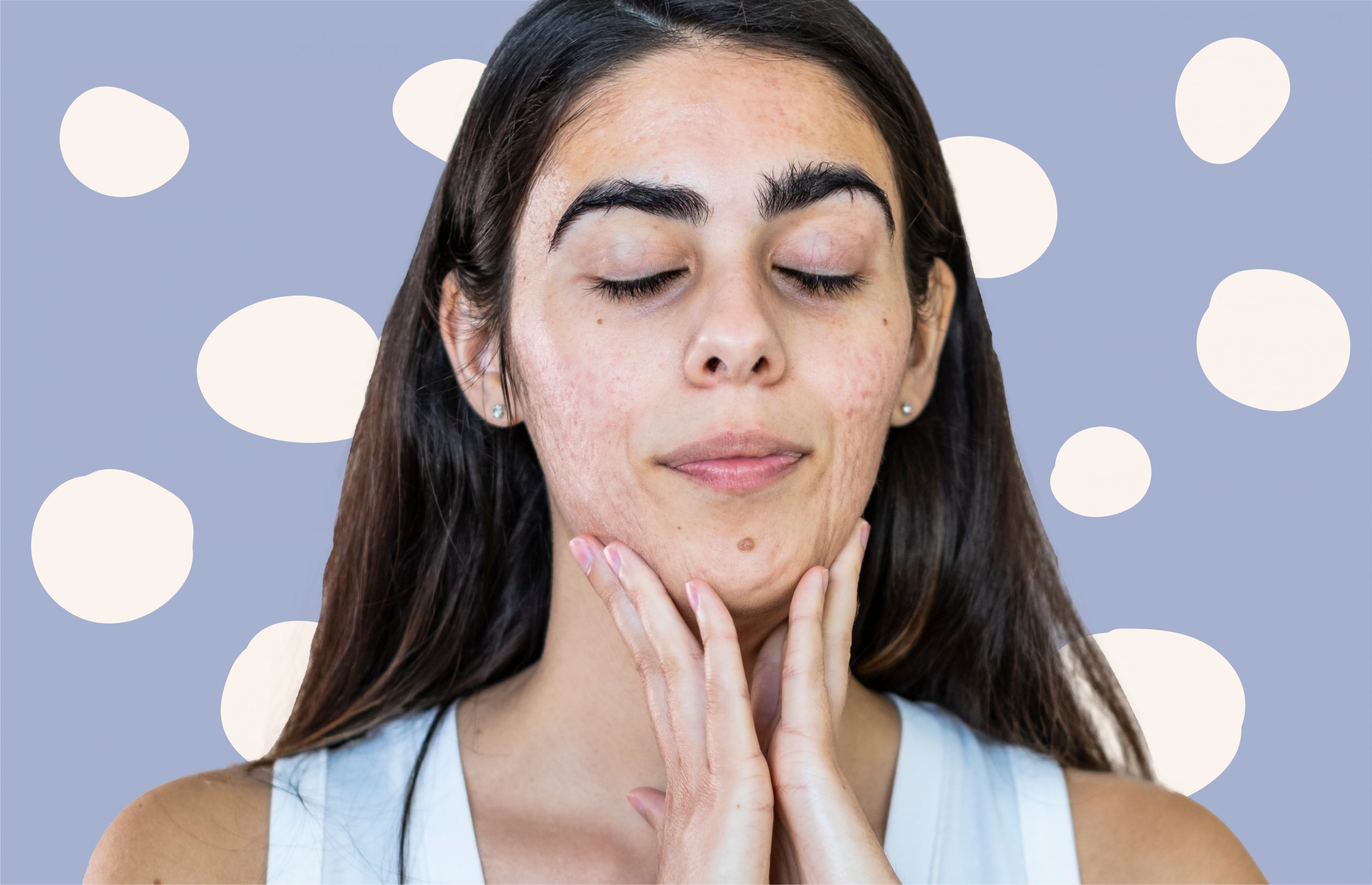 Does Touching Your Face Cause Acne?