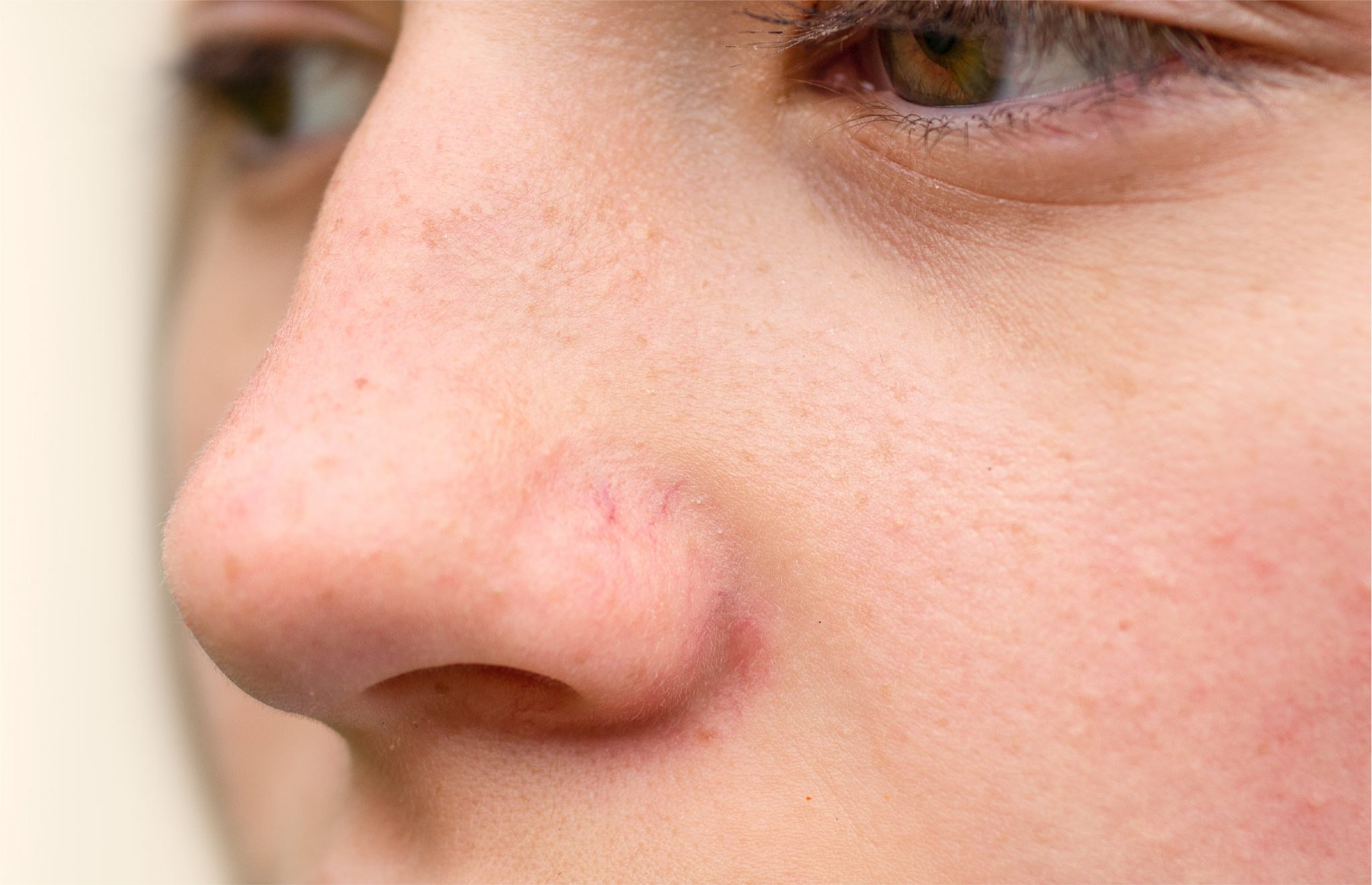 7 Ways to Address Broken Blood Vessels on the Face