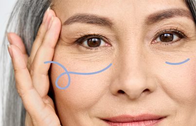 What to Do About Puffy Eyes