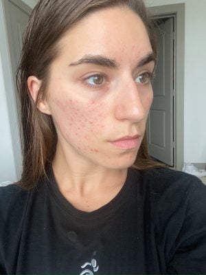 tips for feeling normal / attractive with dark scars?? they look