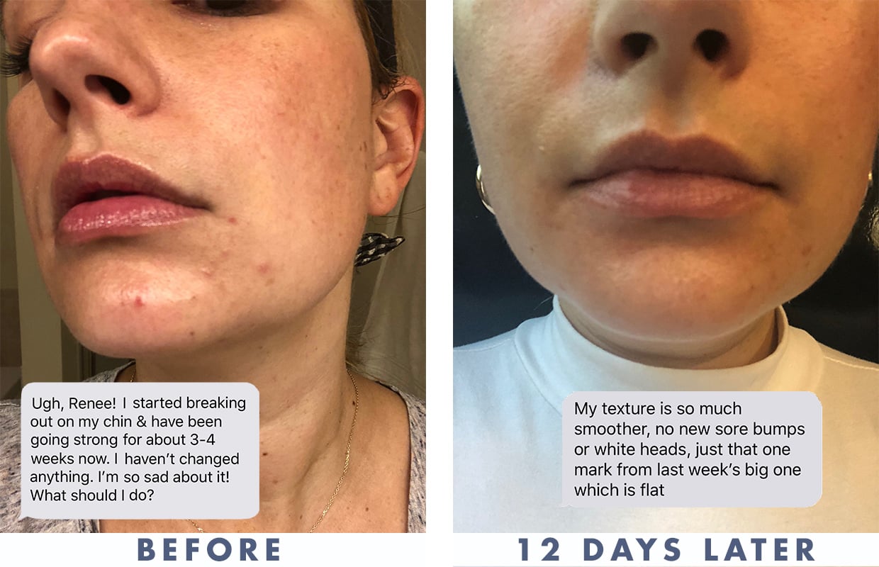 need-permanent-solutions-for-body-acne-connect-my-clinic-back-acne