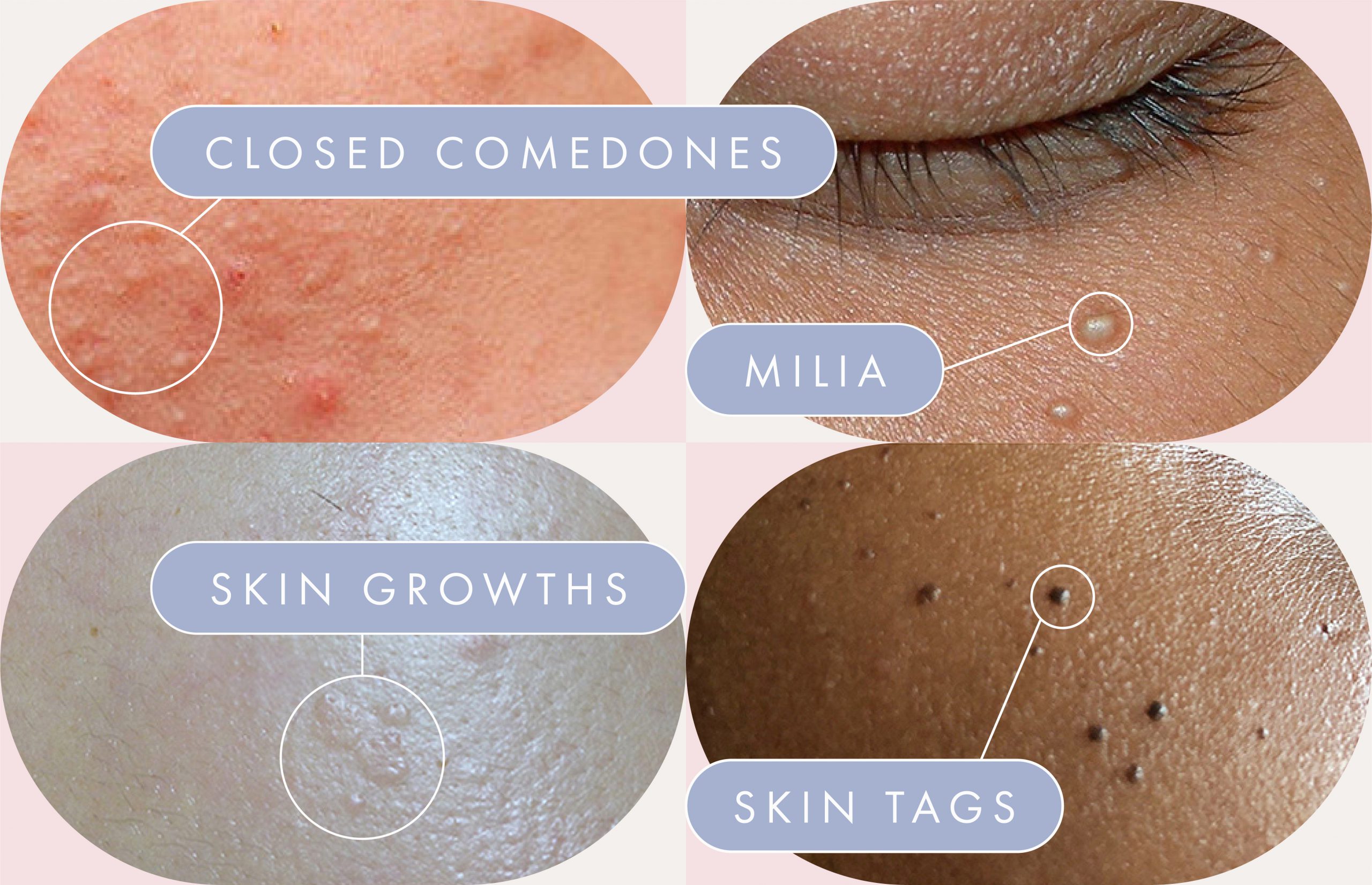 gård over support Bumps on the Skin on Your Face: What They Are and What You Can Do