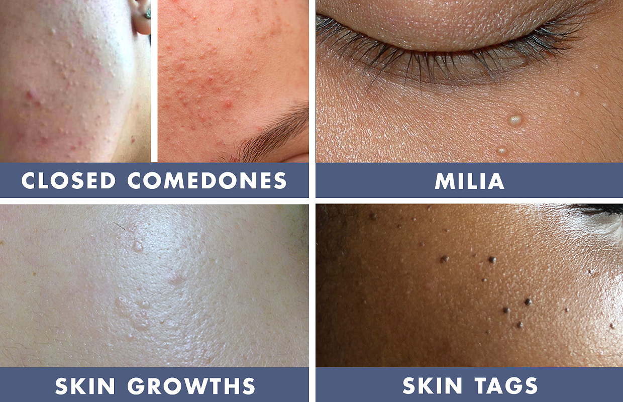 Bumps On The Skin Age Bumps Skin Growths And Clogged Pores