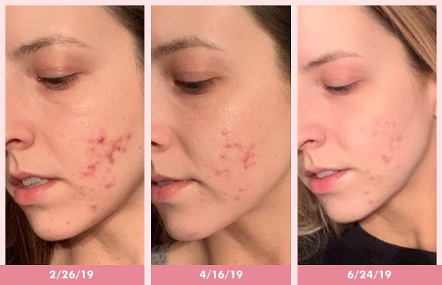 How To Cover Acne With Makeup—A Artist's Story