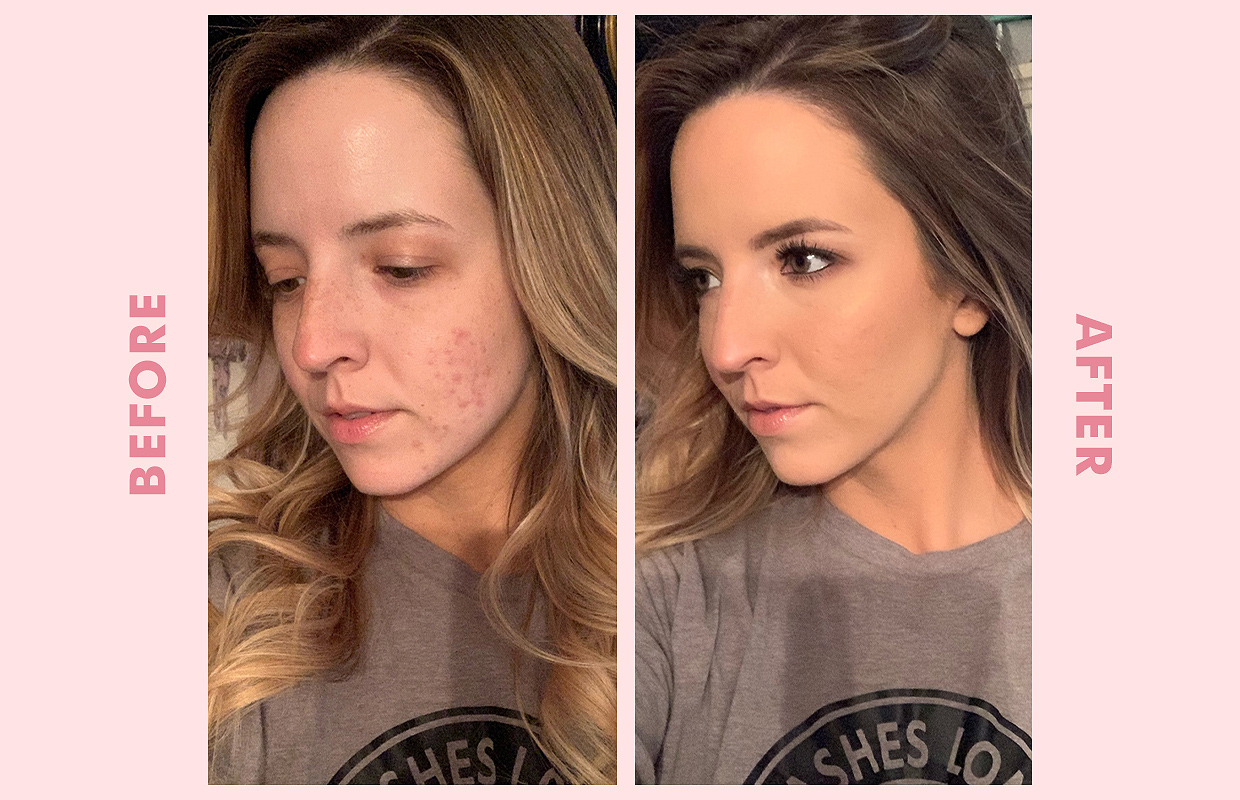 How To Cover Acne With Makeup—A Makeup Artist's Story