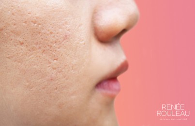 Close-up of woman's skin showing indented, depressed acne scars