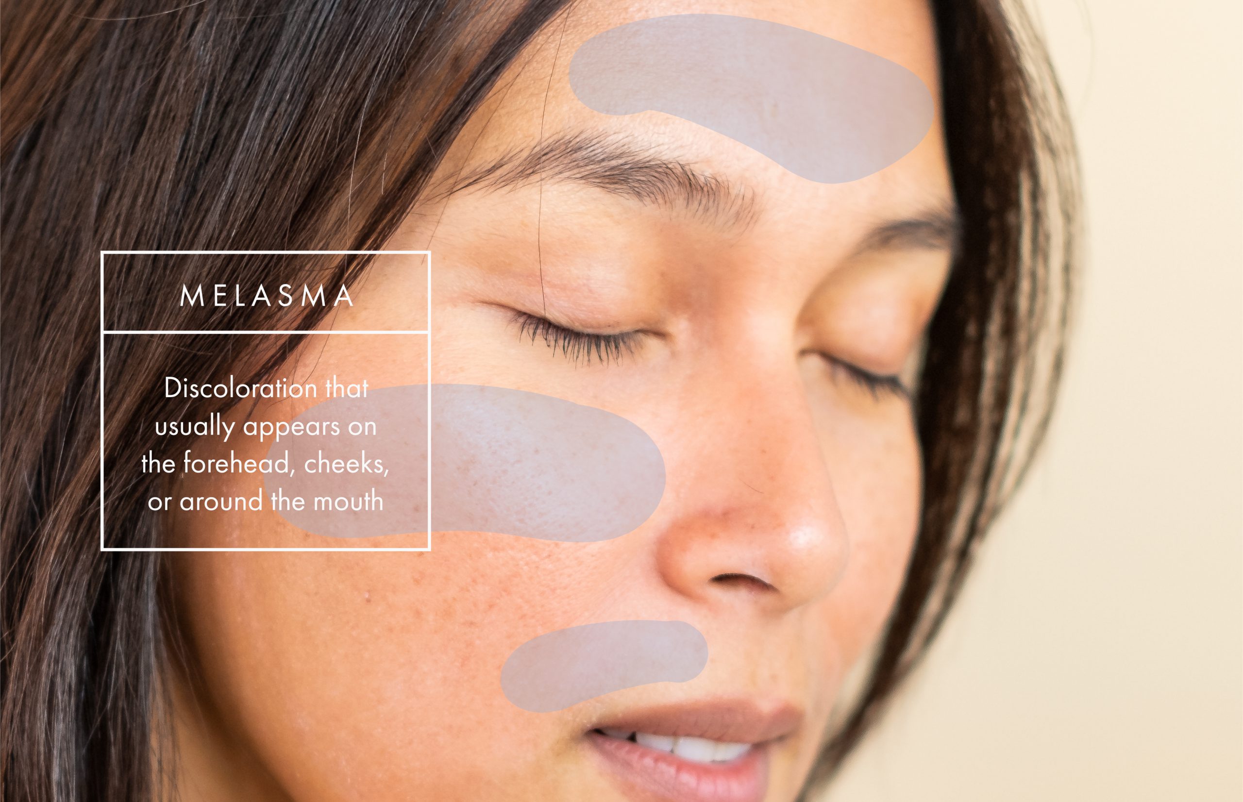 Skin Discoloration Has Many Causes—and Just As Many Treatment Options