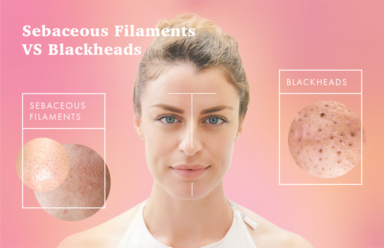 Sebaceous Filaments vs. Blackheads: How to Rid Them
