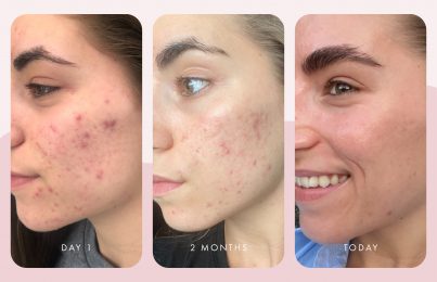 Meet Priscilla: She Struggled With Breakouts For Years—Here's How She Cleared Her Skin