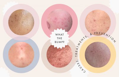 Your Complete Guide to Clearing Clogged Pores—Once and For All
