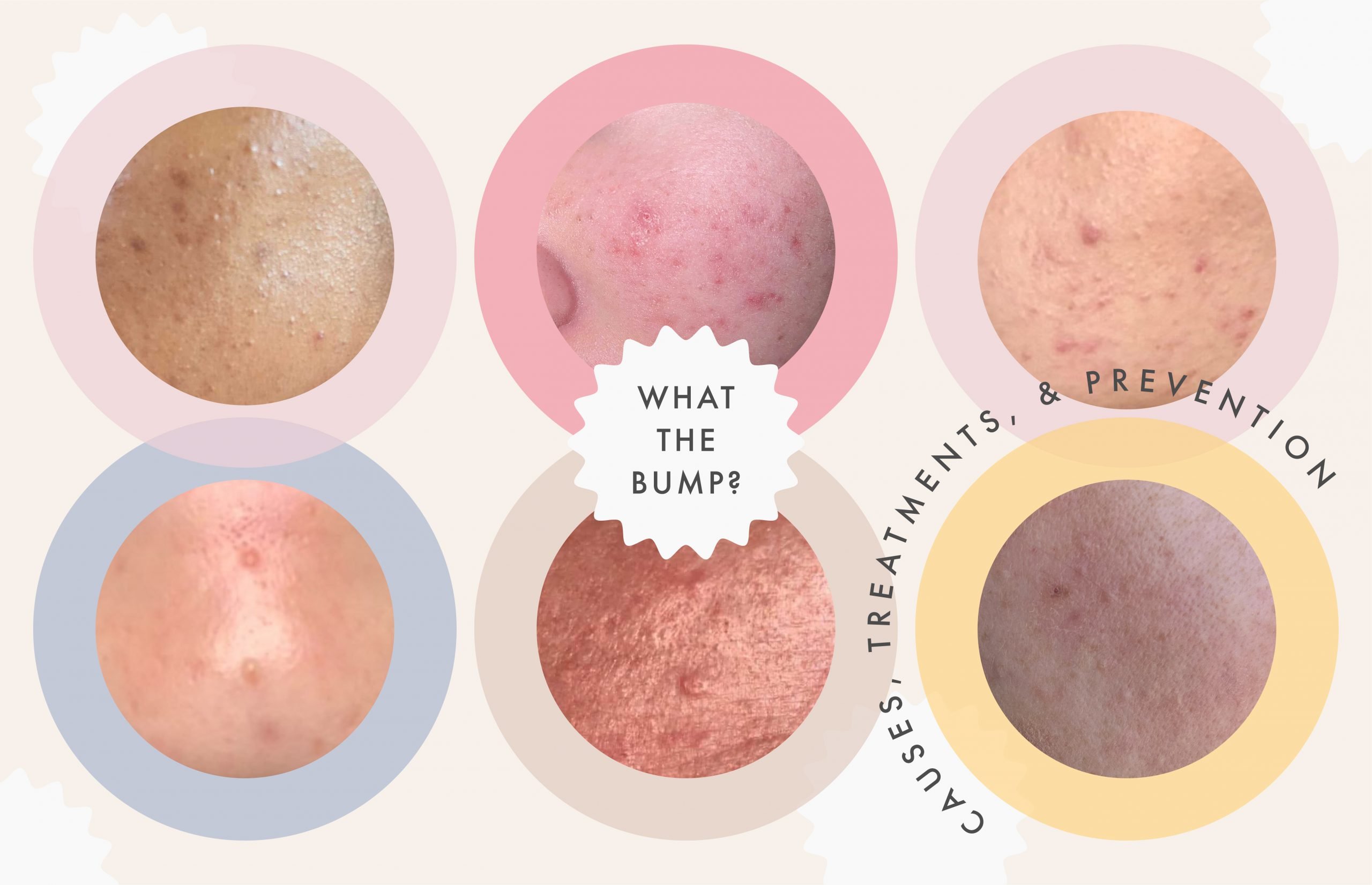 A Complete Guide to Clearing the Different Types of Clogged Pores