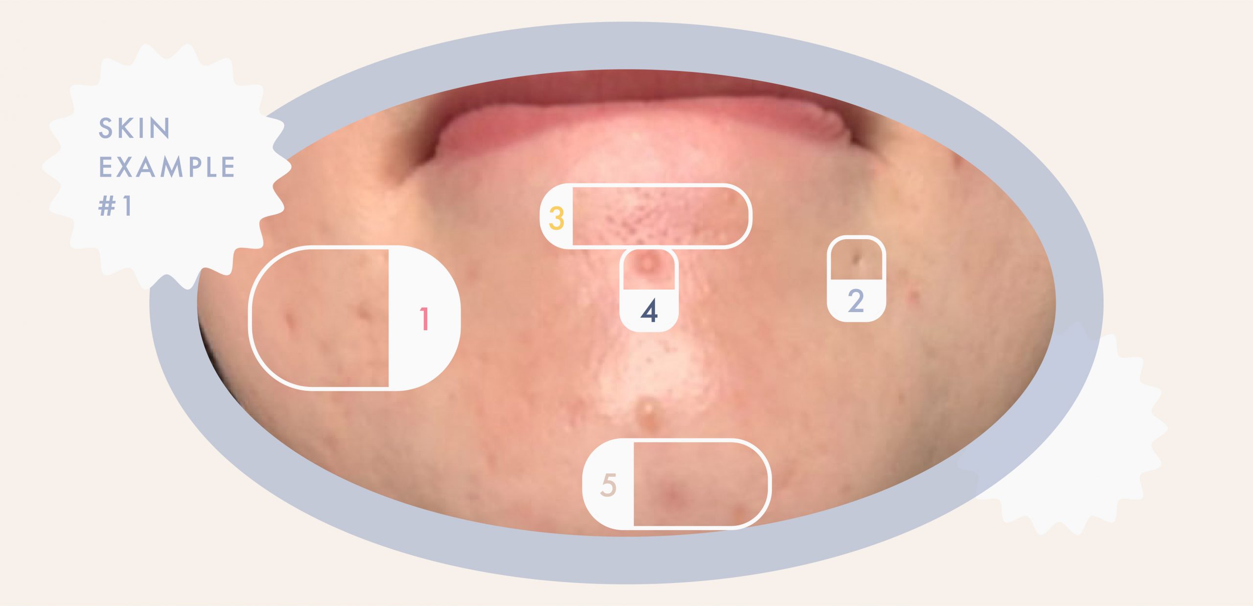 Enlarged pores on a woman's chin
