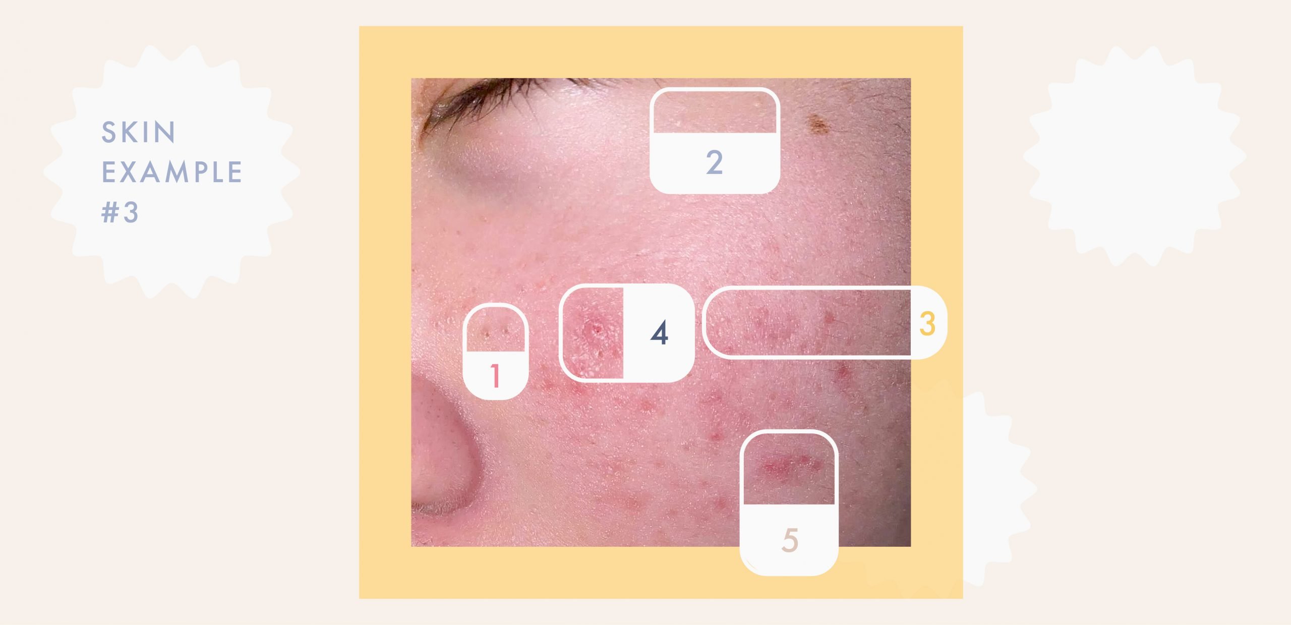 A Complete Guide to Clearing the Different Types of Clogged Pores