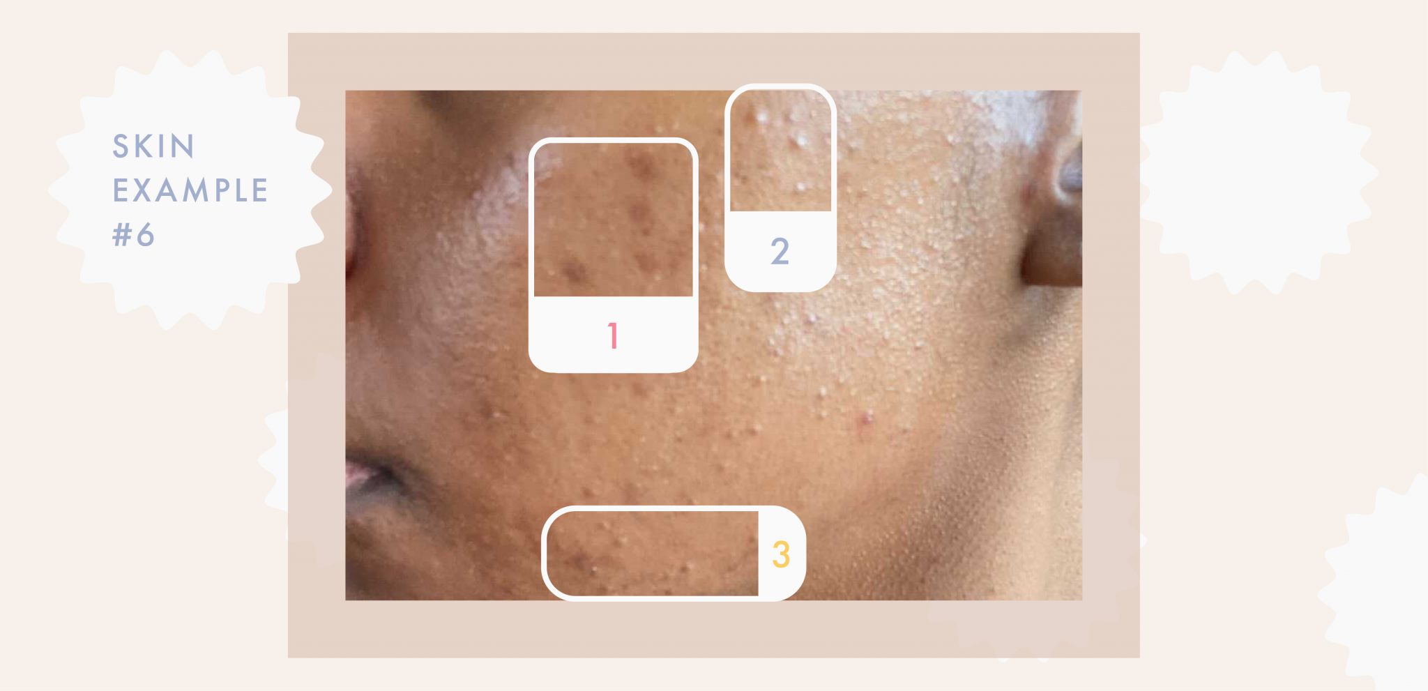 A Complete Guide to Clearing the Different Types of Clogged Pores