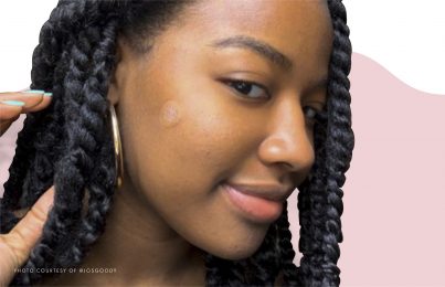 Young woman shows off a pimple patch on her cheek