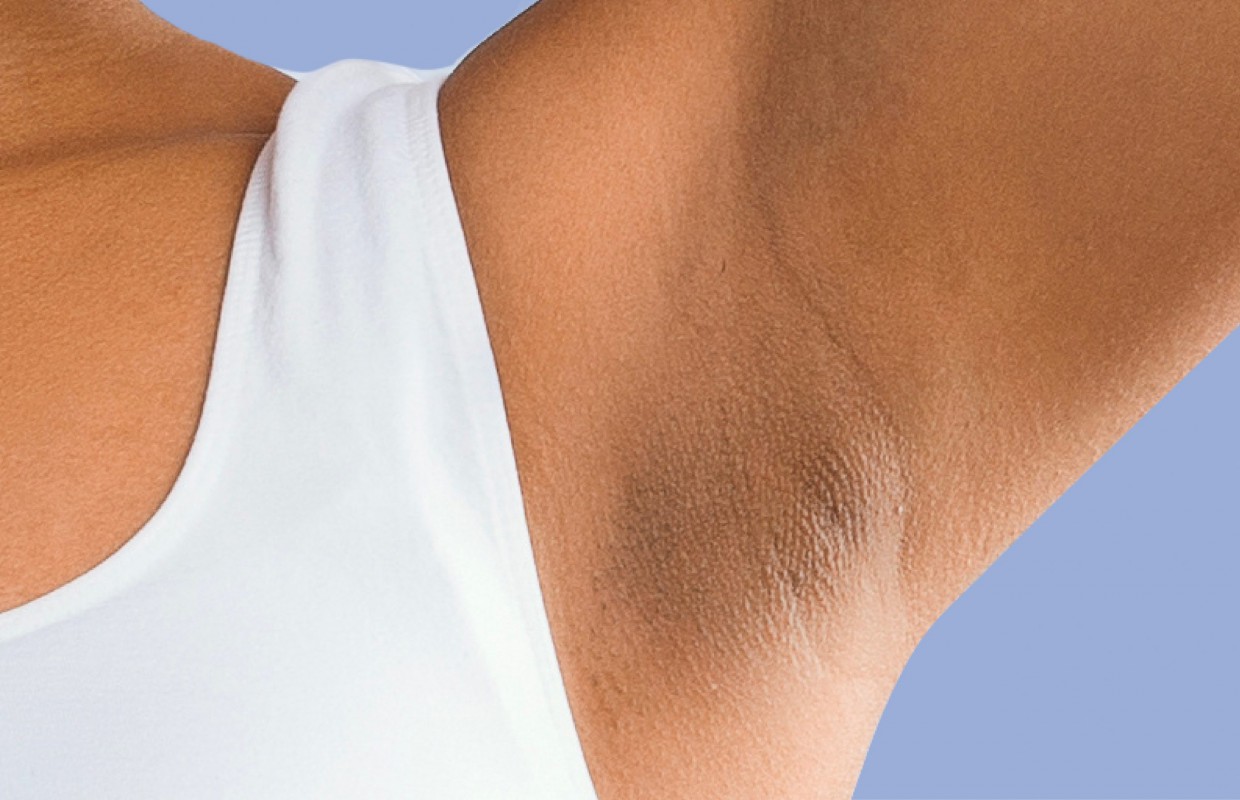 skin tags in armpit