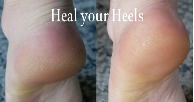 cracked heels before and after