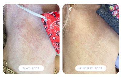 Here's How Renée Fades Redness On Her Neck With Skincare and Treatments