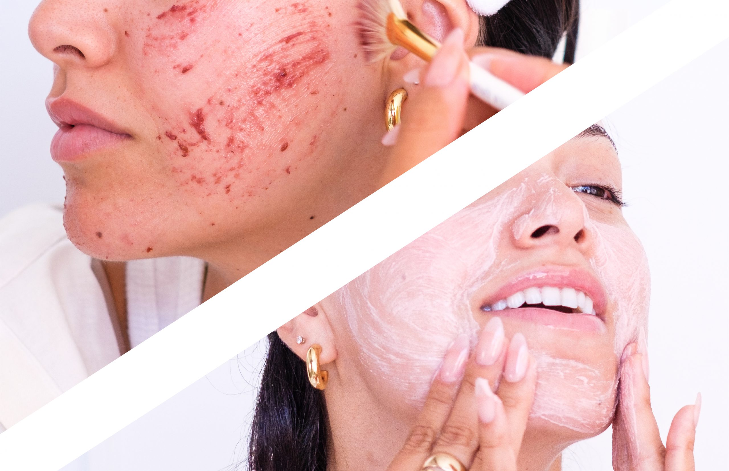 This 2-Step Exfoliation Method Fades Hyperpigmentation and Dark Spots Faster