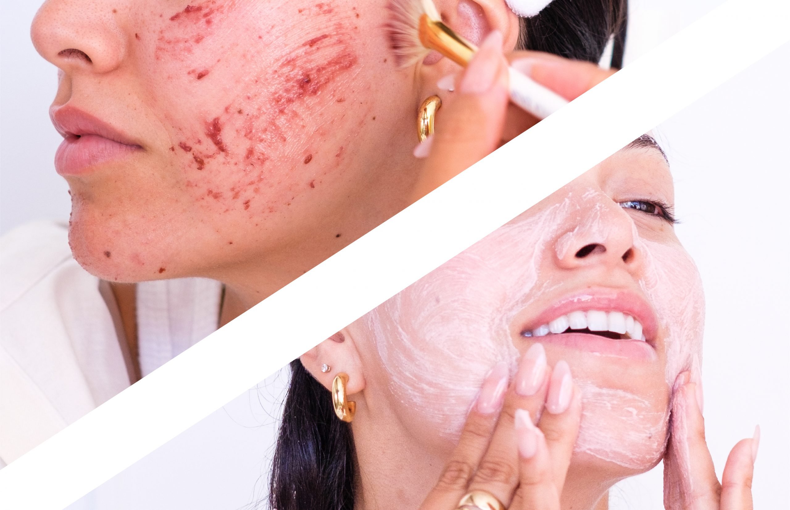 This 2-Step Exfoliation Method Fades Hyperpigmentation and
Dark Spots Faster