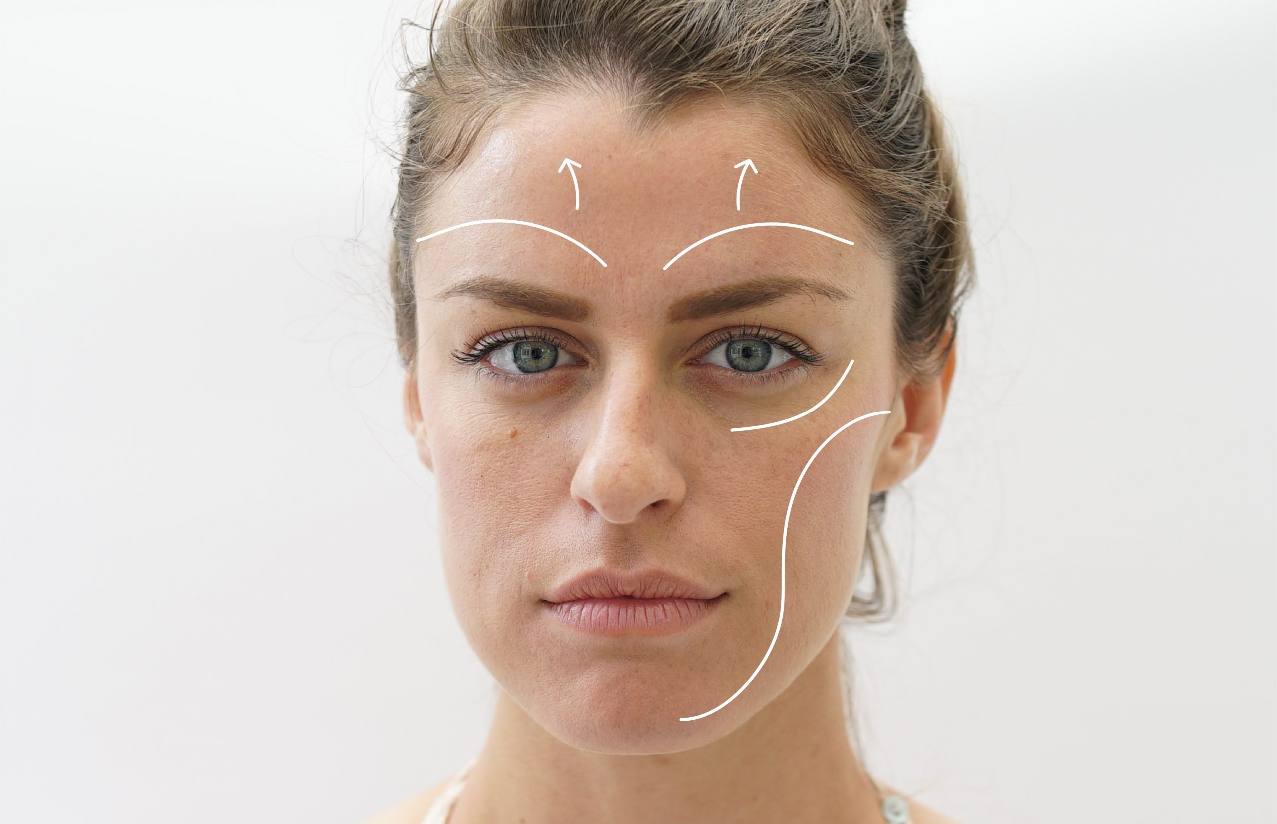 a woman with facelift markings on her face