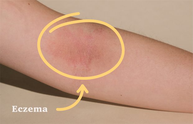 Eczema skincare