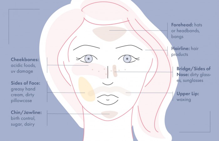 Face Mapping for Acne—Recurring Breakouts In the Same Place